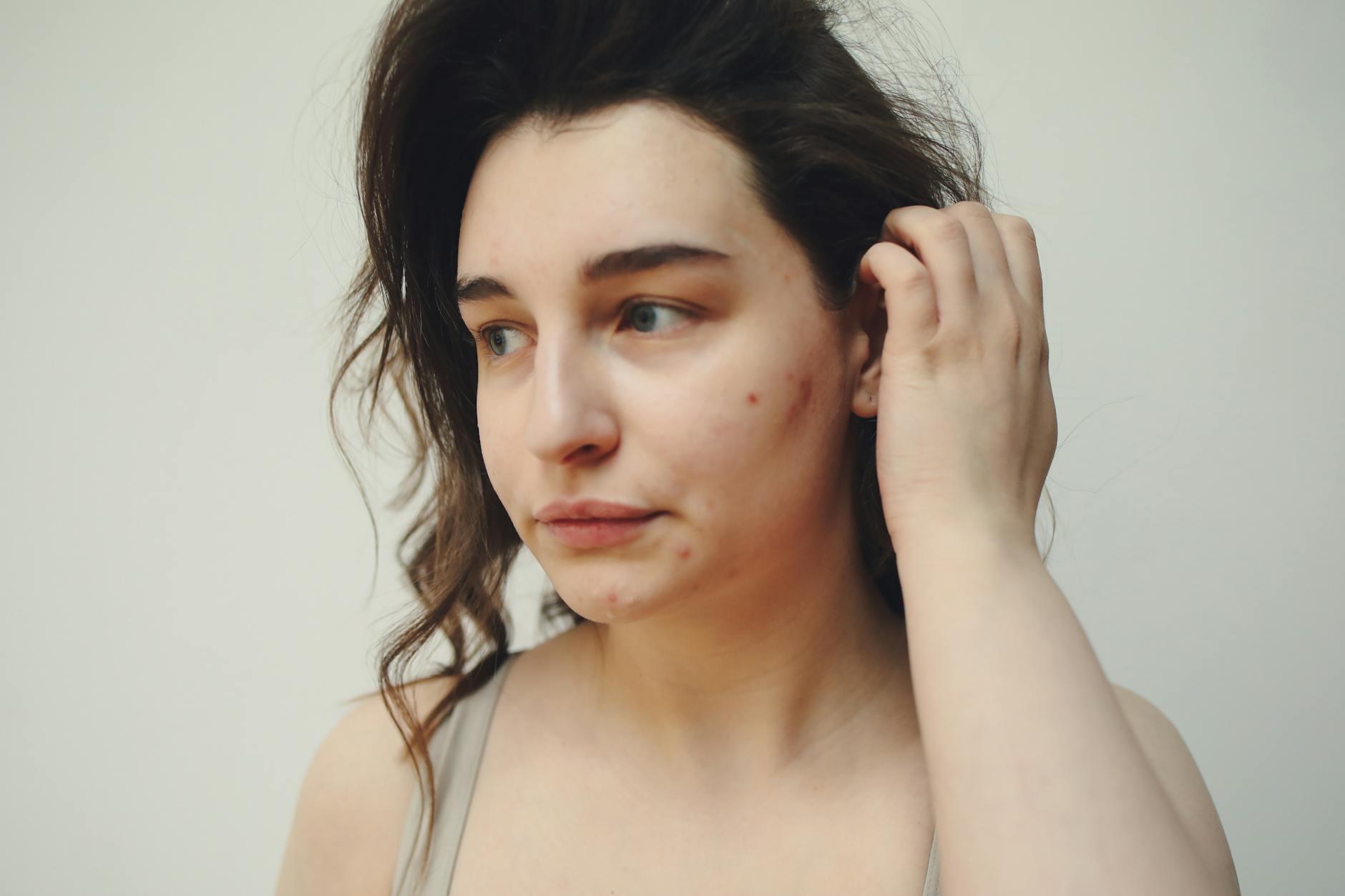 Close-up portrait of a woman with visible acne marks, showcasing natural beauty.